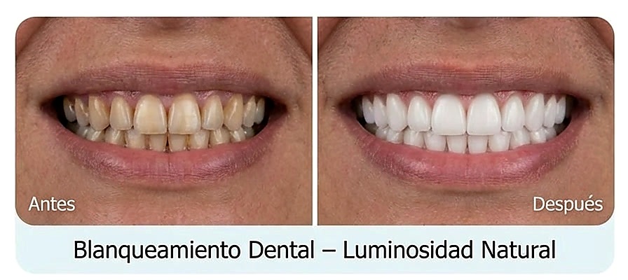 Antes y después blanqueamiento dental ORIS