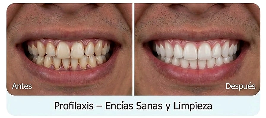 Antes y después profilaxis dental ORIS